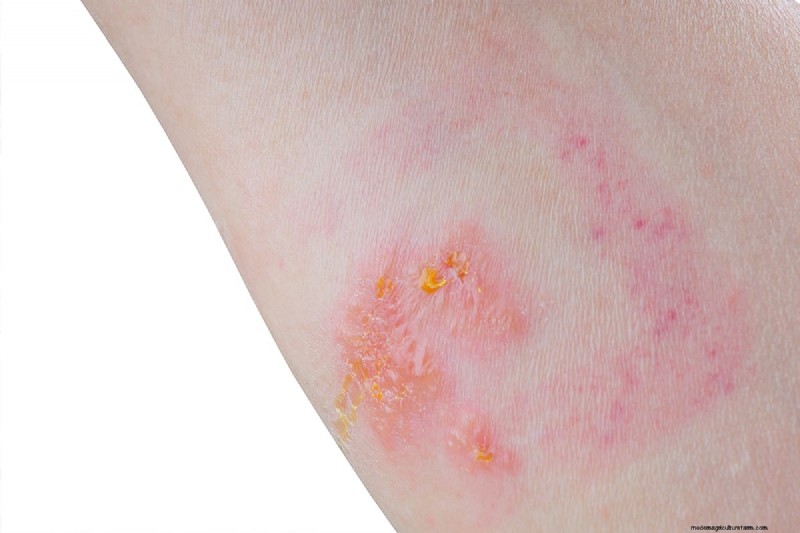 Apakah Poison Ivy Layu di Musim Dingin? Panduan Ahli untuk Identifikasi, Perawatan, dan Penghapusan Aman 